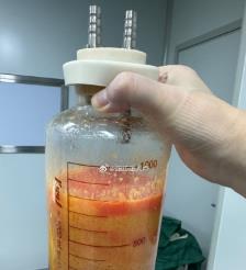 驻马店水动力吸脂手术要做多久？